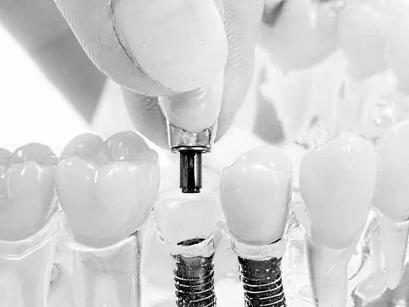 Implantate mit aufgesetzten Kronen im Modell